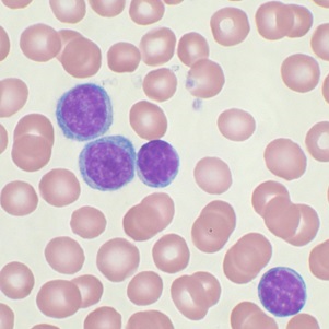 MDP has successfully completed enrolment for study in patients with Chronic lymphocytic leukemia (CLL)
